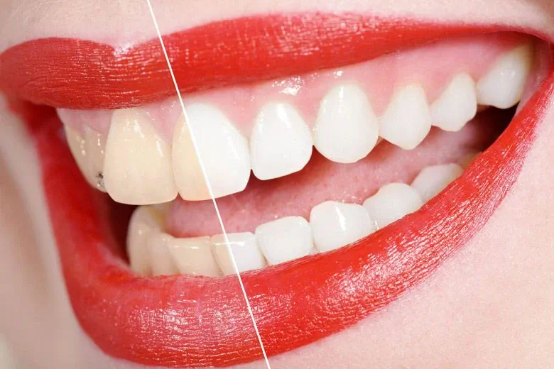 Igiene orale e sbiancamento dentale con lampada